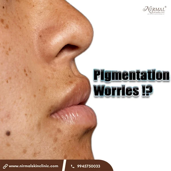Pigmentation isn’t just a cosmetic issue — it’s your skin asking for help.
Whether it's melasma, sun spots, or post-acne marks, pigmentation has deeper triggers like hormonal changes, sun exposure, and even PCOD.

At Nirmal Skin & Hair Clinic, we diagnose the type of pigmentation before treating it with:
✨ Q-Switched ND:YAG Laser
✨ Chemical peels with actives like kojic acid & mandelic acid
✨ Dermatologist-supervised skin lightening protocols

No random creams. No false promises. Just real science, real results.
Let your skin breathe, brighten, and bounce back. 🌿

📞 Book your pigmentation consultation today
📍 Vijayanagar, Bengaluru
🌐 www.nirmalskinclinic.com | 📱 9945750033

#PigmentationTreatment #MelasmaSolution #SkincareBangalore #QSwitchedLaser #NirmalSkinClinic #DermatologistBangalore #EvenSkinTone #SkinClinicIndia #HyperpigmentationFix #AcneMarksRemoval