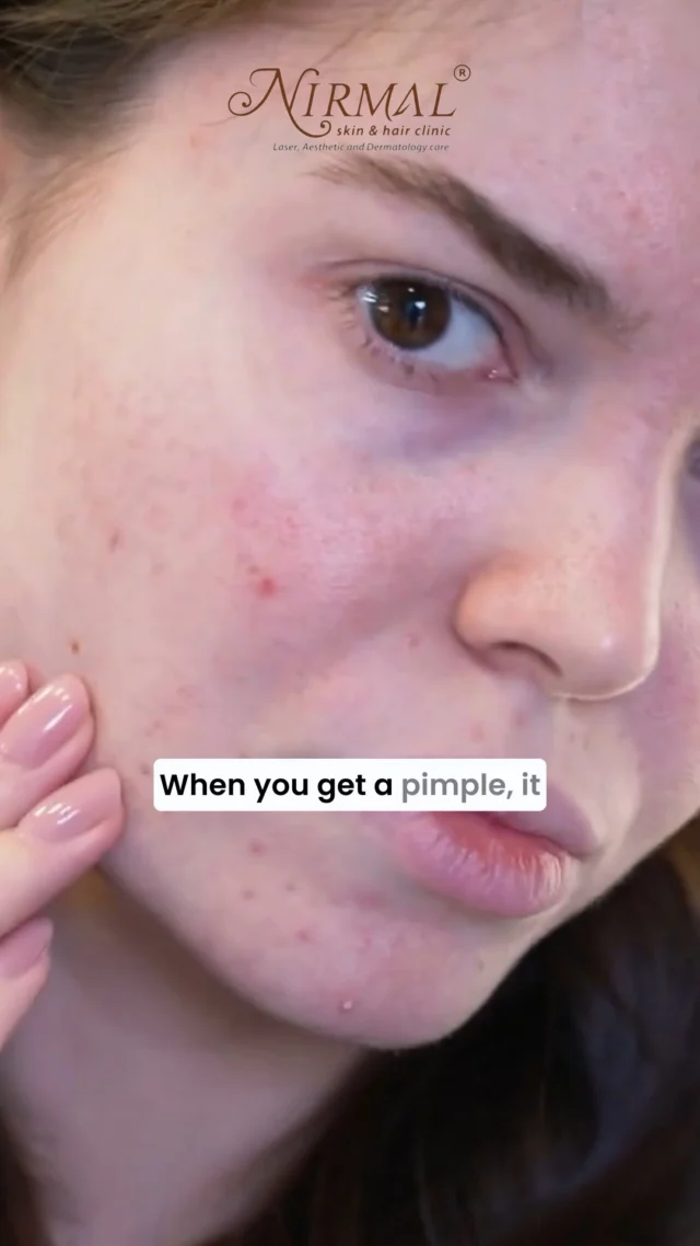 The #science of #pimples 

For appointments and queries get in touch with us
☎️08023380138
📱9945750033, 08071899111

#DermatologistApproved
#SkinCareByDermatologist
#CosmeticDermatology
#BoardCertifiedDermatologist
#DermatologistRecommended
#SkinHealthExpert
#DermatologistTips
#SkinCareSolutions
#DermatologyExpert
#skincareadvice